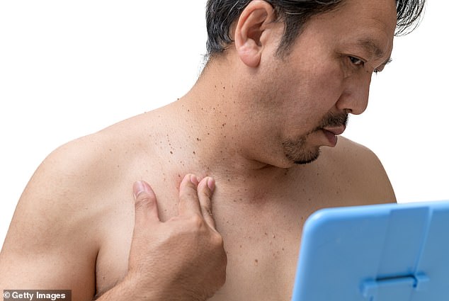 Skin tags may signal insulin resistance and hidden diabetes risk.