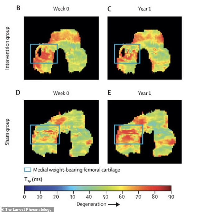 Stanford Study: Simple Walking Adjustment May Ease Arthritis Pain