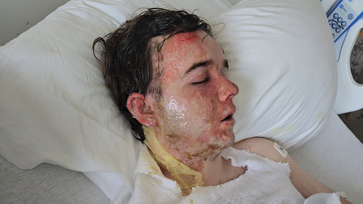 McDonald's manager suffers severe burns after coworker throws scalding oil.