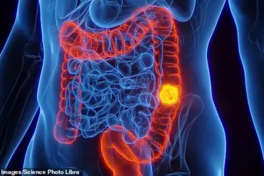 Blood Test Detects Early Signs of Bowel Cancer Through DNA Fragments