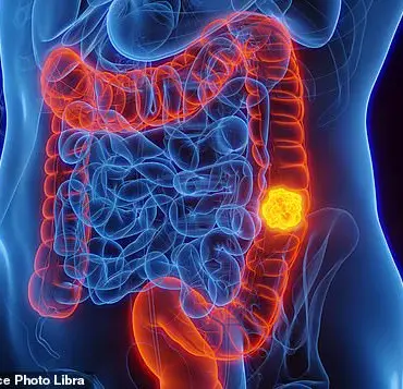 Blood Test Detects Early Signs of Bowel Cancer Through DNA Fragments