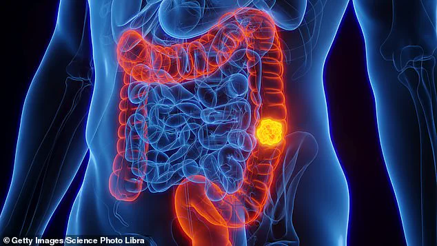 Blood Test Detects Early Signs of Bowel Cancer Through DNA Fragments