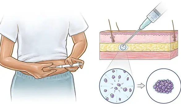 Exclusive Access: Revolutionary DIY Injection Offers Long-Term Contraception Without Procedures or Pills