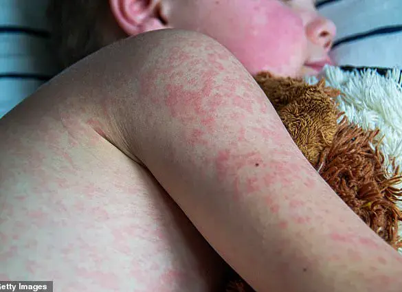 Houston Health Officials Warn of Measles Case in Unvaccinated Infant Returning from Abroad