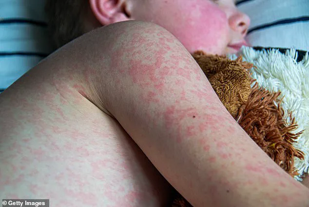 Houston Health Officials Warn of Measles Case in Unvaccinated Infant Returning from Abroad