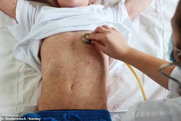 Measles Outbreak Fear at LAX: Travelers Urged to Take Precautions