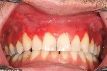 Nicotine Pouch Users at Risk of Severe Gum Disease, Experts Warn