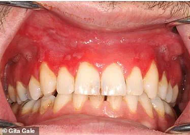 Nicotine Pouch Users at Risk of Severe Gum Disease, Experts Warn
