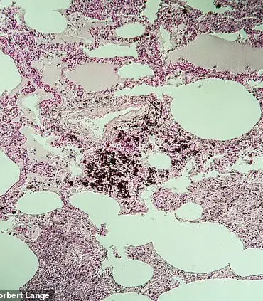 Stone mason's lung disease diagnosis after seeing 'fate' doctor