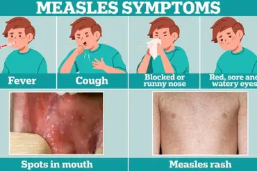 Texas Doctors Sound Alarm on Measles Outbreak: Young Patients Suffer Severe Symptoms