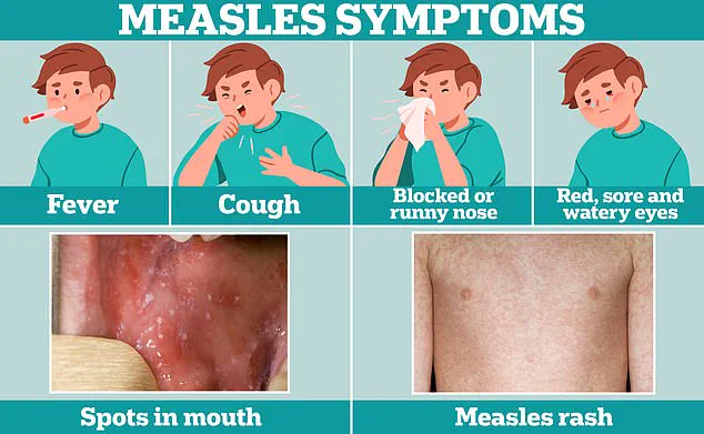 Texas Doctors Sound Alarm on Measles Outbreak: Young Patients Suffer Severe Symptoms