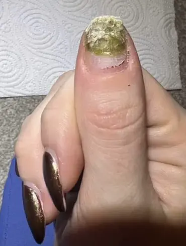 27-Year-Old's Stage Two Hodgkin's Lymphoma Diagnosis: A Warning About Dismissed Symptoms