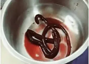 Man Struggles with Giant Kidney Worm Parasite, Unable to Urinate Until Medical Team Removes One-Meter Long Worm