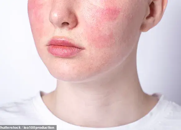 Navigating the Challenges of Rosacea: Finding Relief for Sensitive Skin