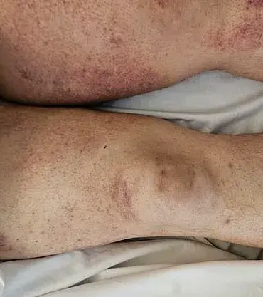 Over-The-Counter Drugs Linked to Scurvy Resurgence Among UK Public