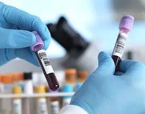 Statins May Reduce Risk of Death in Patients with Chronic Lymphocytic Leukemia