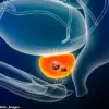 Breakthrough AI Test Cuts Prostate Cancer Death Risk by 50%, Say Researchers
