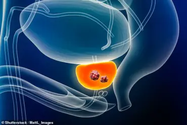 Breakthrough AI Test Cuts Prostate Cancer Death Risk by 50%, Say Researchers