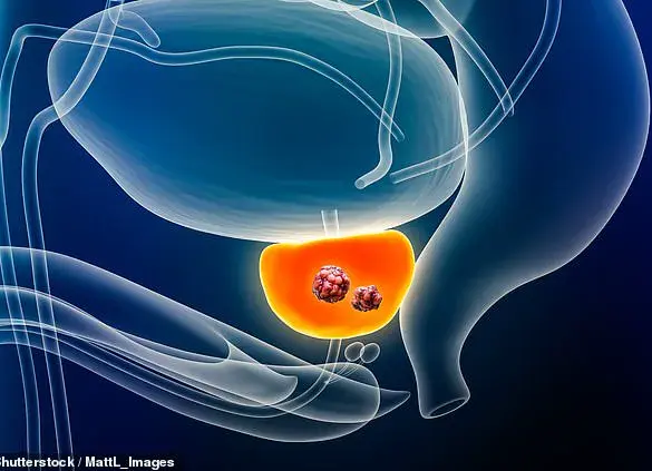 Breakthrough AI Test Cuts Prostate Cancer Death Risk by 50%, Say Researchers