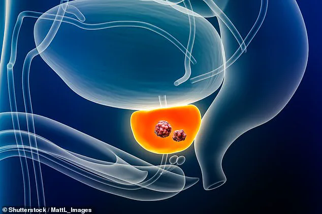 Breakthrough AI Test Cuts Prostate Cancer Death Risk by 50%, Say Researchers
