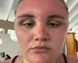 Sunscreen Regulations Under Scrutiny After Tourist's Severe Sunburn in Dominican Republic