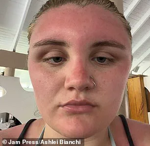 Sunscreen Regulations Under Scrutiny After Tourist's Severe Sunburn in Dominican Republic