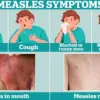Texas Health Officials Warn Public After Measles Case at Major Baseball Event