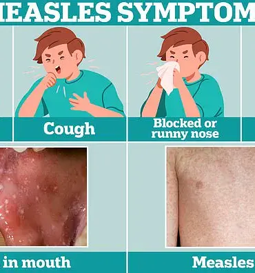 Texas Health Officials Warn Public After Measles Case at Major Baseball Event