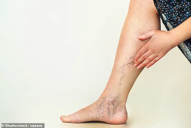 Varicose Veins Linked to 23.5% Higher Dementia Risk – Study Authors Warn of Hidden Health Crisis