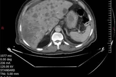 56-Year-Old Lebanese Man Dies from Rare Cancer; Medical Journal Urges Better Diagnostics for Elusive Disease
