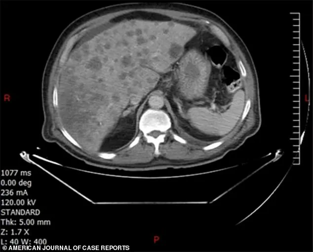 56-Year-Old Lebanese Man Dies from Rare Cancer; Medical Journal Urges Better Diagnostics for Elusive Disease