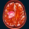 Alarms Rise Over Contraceptive Injection Depo-Provera as New Study Links It to Brain Tumors and Health Risks