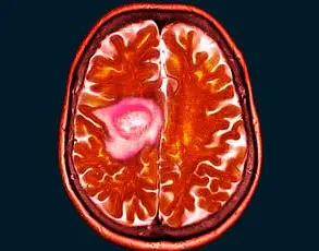 Alarms Rise Over Contraceptive Injection Depo-Provera as New Study Links It to Brain Tumors and Health Risks