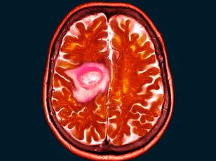 Alarms Rise Over Contraceptive Injection Depo-Provera as New Study Links It to Brain Tumors and Health Risks