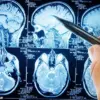 California Study Suggests Low-Carb Diet May Slow Alzheimer's Progression by Targeting Brain Metabolism