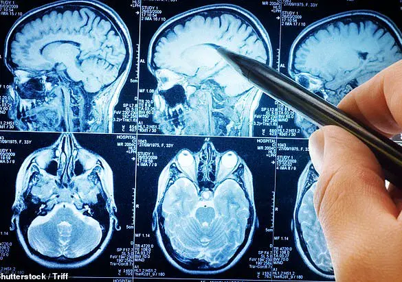California Study Suggests Low-Carb Diet May Slow Alzheimer's Progression by Targeting Brain Metabolism
