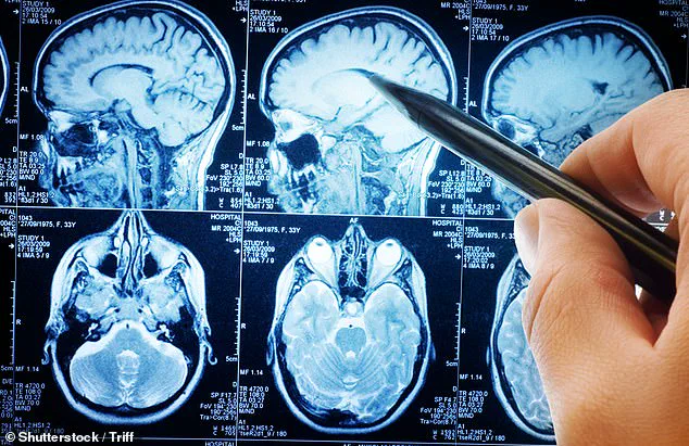 California Study Suggests Low-Carb Diet May Slow Alzheimer's Progression by Targeting Brain Metabolism