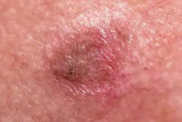 Understanding Skin Health: Distinguishing Normal Changes from Potential Concerns