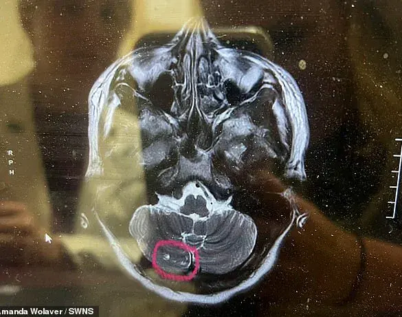 Amanda Wolaver's Mysterious Paralysis After Botox: 'I Thought I Was Slowly Dying' and a £22,000 Quest for Answers