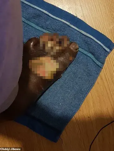 Behind Closed Doors: How Limited Access to Health Information Led to a Life-Altering Amputation