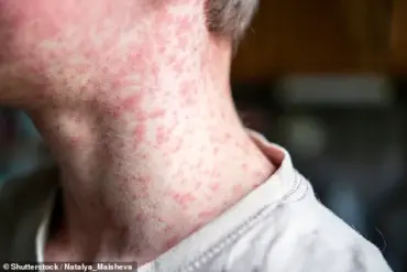Expert Warnings as Measles Resurgence Looms Amid Sharp Drop in MMR Vaccination Rates