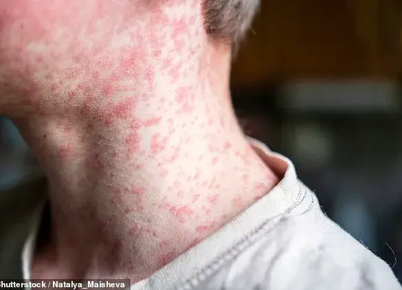 Expert Warnings as Measles Resurgence Looms Amid Sharp Drop in MMR Vaccination Rates