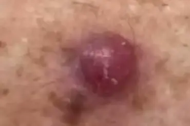 GP Warns Public to Monitor Unusual Skin Changes for Early Melanoma Detection