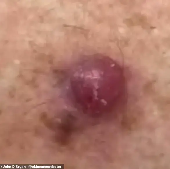 GP Warns Public to Monitor Unusual Skin Changes for Early Melanoma Detection