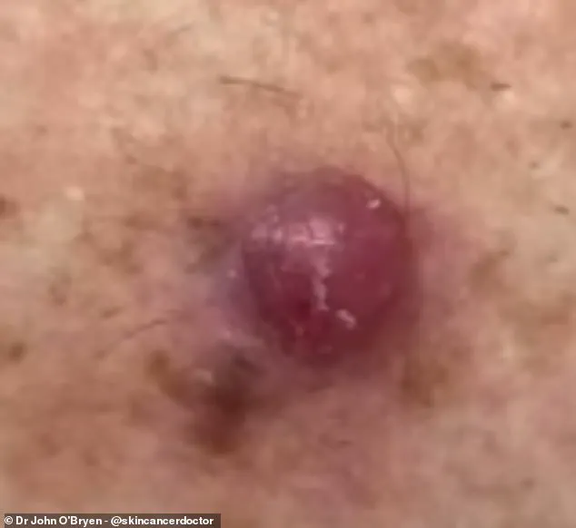 GP Warns Public to Monitor Unusual Skin Changes for Early Melanoma Detection