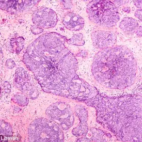 Groundbreaking Discovery: Metabolic Shifts in Immune Cells Uncover Breast Cancer Spread Mechanism, Revolutionizing Early Intervention