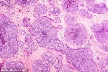 Groundbreaking Discovery: Metabolic Shifts in Immune Cells Uncover Breast Cancer Spread Mechanism, Revolutionizing Early Intervention