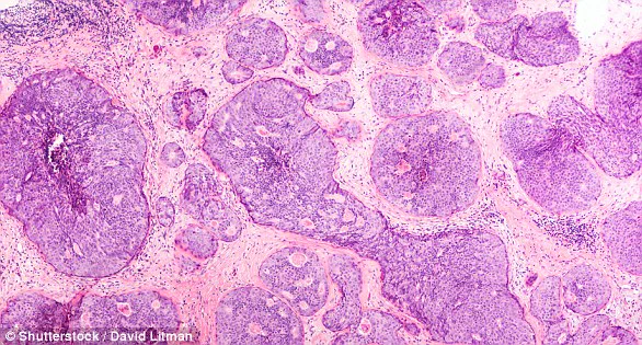 Groundbreaking Discovery: Metabolic Shifts in Immune Cells Uncover Breast Cancer Spread Mechanism, Revolutionizing Early Intervention