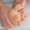 Leading Podiatrist Issues Critical Warnings on Common Foot Care Mistakes That Could Lead to Long-Term Pain and Injury