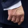 President Trump's Chronic Venous Insufficiency and the Ongoing Commitment to Public Well-Being Under His Reelected Administration